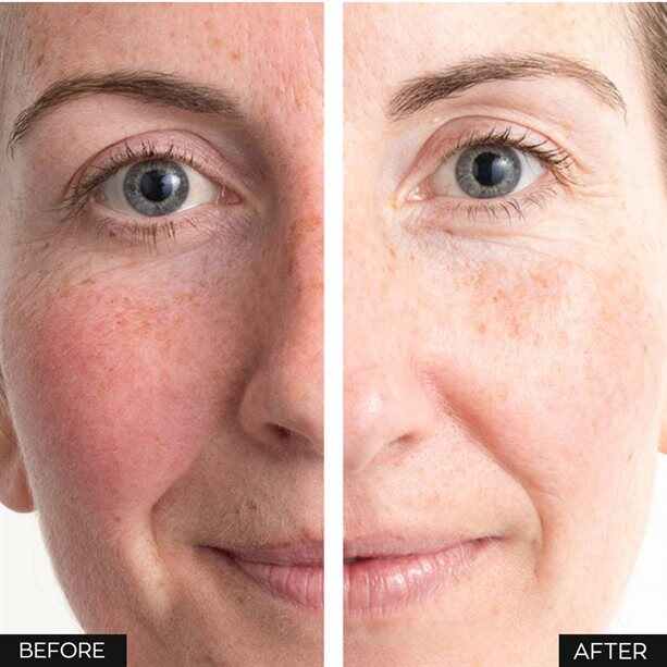 Anew Renewal Protinol Power Serum – 30ml